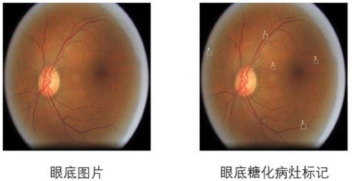 糖尿病眼底筛查-1024x527.jpg
